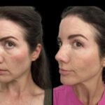 Why Celebrities Prefer Advanced Dark Circles Treatment in Dubai for a Youthful Appearance