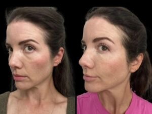 Why Celebrities Prefer Advanced Dark Circles Treatment in Dubai for a Youthful Appearance