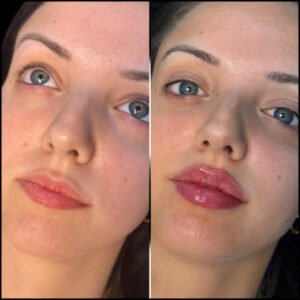 Best Aesthetic Clinic in Dubai for Fillers: Achieve Symmetry and Balance