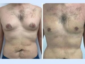 How to Prepare Physically for Gynecomastia in Dubai Surgery
