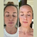 Reveal Timeless Beauty with the Best Plastic Surgeons in Dubai Using Fotona 4D Laser