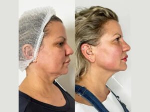 How Endolift Treatment in Dubai Helps You Achieve a Naturally Youthful Look