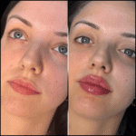 Fillers Treatment in Dubai: Transform Your Look Instantly
