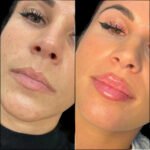 Fillers Treatment in Dubai: Enhancing Your Natural Glow