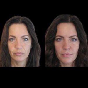 Best Aesthetic Clinic in Dubai for Jawline Fillers: The Secret to a Defined Look