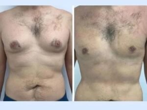 Best Gynecomastia Surgeons in dubai Experience Seamless Gynecomastia Recovery