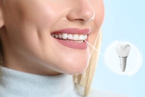 How Do Dental Implants Improve Oral Health And Smile?