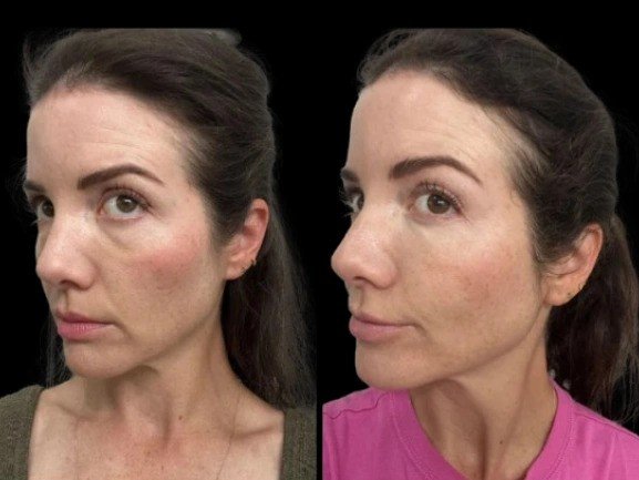 Best Doctors in Dubai Compare Laser and Injectable Options for Dark Circles Treatment