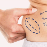 How to Prepare Strategically for Liposuction Surgery in Dubai