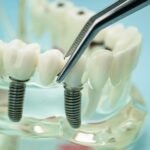 Hidden Costs of Dental Implants You Should Know