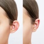 Ear Reshaping Recovery in Islamabad