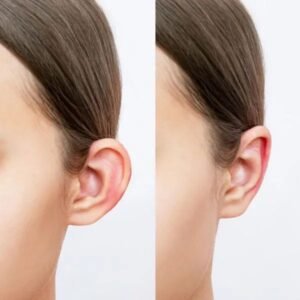 Ear Reshaping Recovery in Islamabad