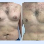 Gynecomastia in Dubai: Timeline for Returning to Work
