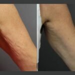 The Most Trusted Moxi Laser Treatment at the Best Aesthetic Clinic in dubai