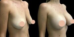 Breast Augmentation in Dubai: How to Prepare for a Successful Surgery
