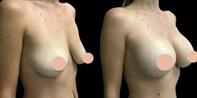 How the Best Breast Augmentation Surgeons in Dubai Handles Complex Revision Surgeries
