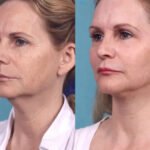 Best Doctors in Dubai Share the Ultimate Guide to Chemical Peel Recovery