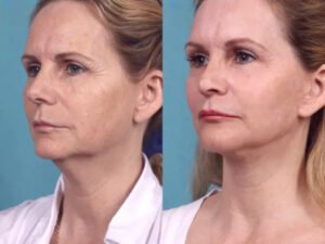 Best Doctors in Dubai Share the Ultimate Guide to Chemical Peel Recovery