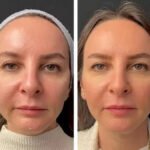 Mesotherapy for Body Contouring: What the Best Aesthetic Clinics in Dubai Offer