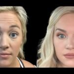 How to Achieve a Natural Look with Botox at the Best Aesthetic Clinic in Dubai