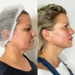Endolift for Face and Neck Contouring by the Best Doctors in Dubai