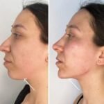 Endolift Treatment in Dubai: Myths vs. Facts You Should Know