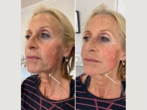 Best Doctors in Dubai to Achieve Youthful Skin with Endolift