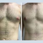 Adapting to a New Body After Gynecomastia Surgery in Dubai