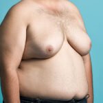 Hormonal Imbalance and Gynecomastia: The Connection Explained