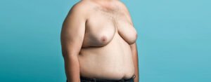 Hormonal Imbalance and Gynecomastia: The Connection Explained