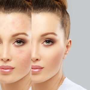 How to maintain results after completing acne scar treatment in Dubai?