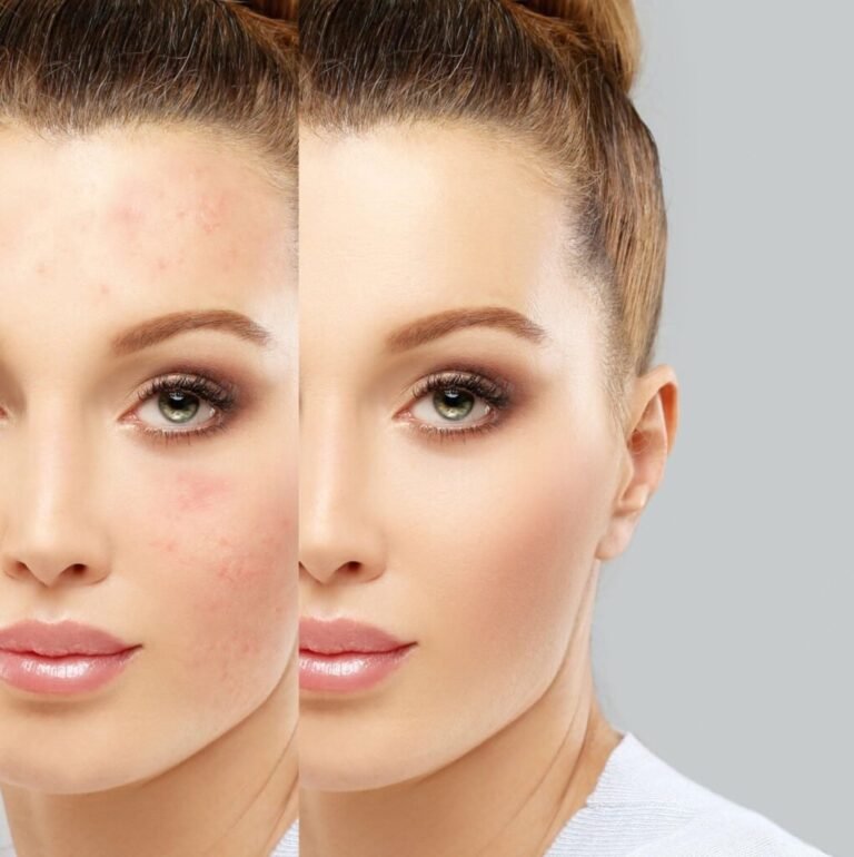How to maintain results after completing acne scar treatment in Dubai?