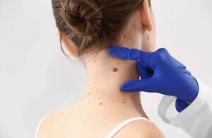 Mole Removal Treatments for Large and Small Moles in Islamabad