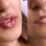 Lip Augmentation Islamabad: Lips That Impress