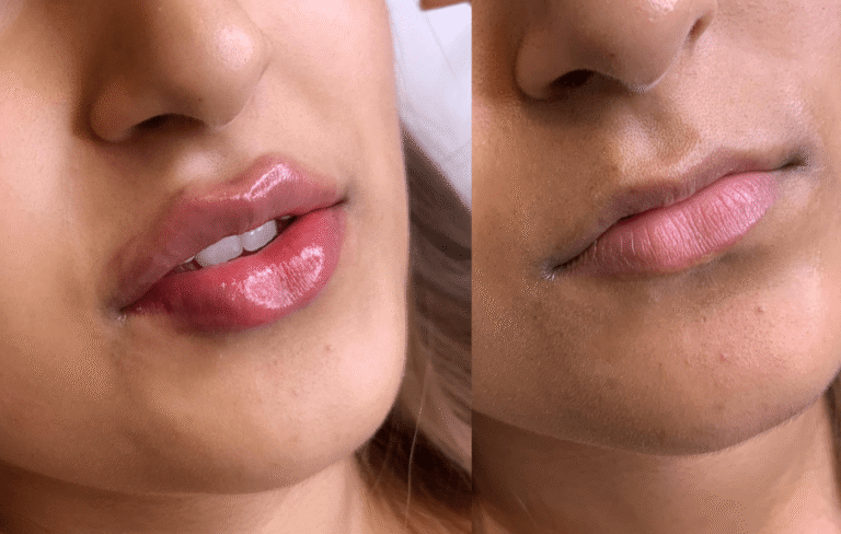 Lip Augmentation Islamabad: Lips That Impress