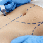 Redefine Your Body with Advanced Liposuction in Islamabad