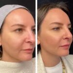 Best Plastic Surgeon in Dubai for Mesotherapy: A Guide for Sensitive Skin Types