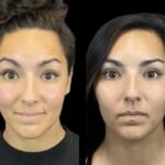 The Rise of Subtle Botox: Insights from the Best Doctors in Dubai