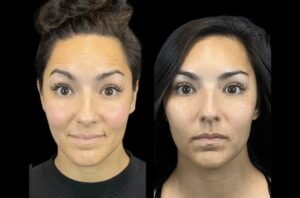 Post-Botox Care Tips Shared by the Best Plastic Surgeons in Dubai