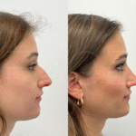 Rhinoplasty Dubai: Achieving Natural Results with Modern Nose Surgery