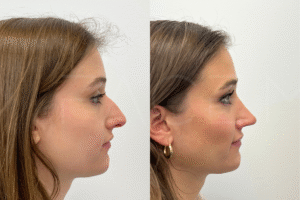 Rhinoplasty Dubai: Achieving Natural Results with Modern Nose Surgery
