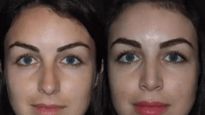 Achieve Stunning Results with the Best Doctors in Dubai for Rhinoplasty