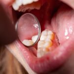 Tooth Filling Cost: Dental Care for Different Age Groups