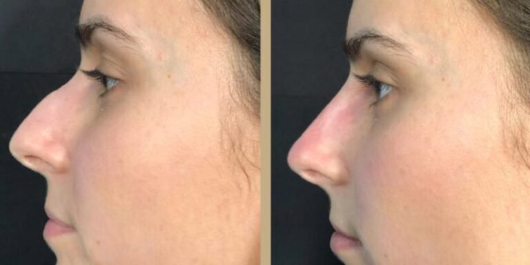 How Long Until You See Results from a Non-Surgical Nose Job?