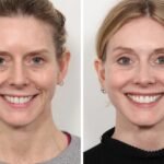 Thread Lift Treatment in Dubai for Advanced Non-Invasive Aesthetics