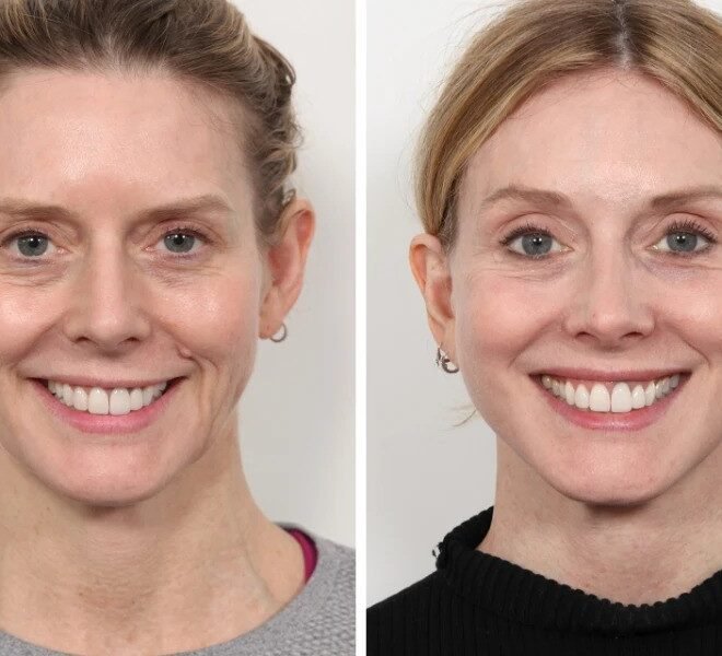 Thread Lift Treatment in Dubai for Advanced Non-Invasive Aesthetics