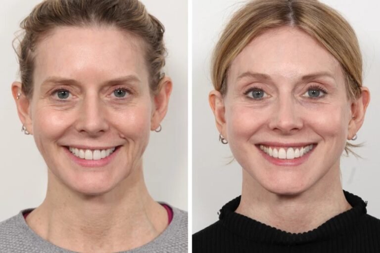 Thread Lift Treatment in Dubai for Advanced Non-Invasive Aesthetics