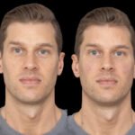 How Best Doctors in Dubai Handle Complications in Under Eye Fillers