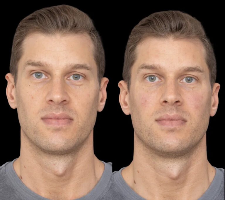 How Best Doctors in Dubai Handle Complications in Under Eye Fillers