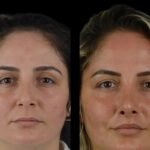 Non-Surgical Face Lifts Using Cheek Fillers by Best Doctors in Dubai